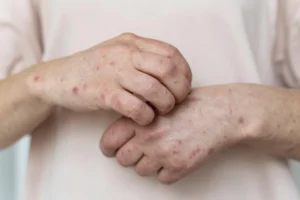 atopic dermatitis