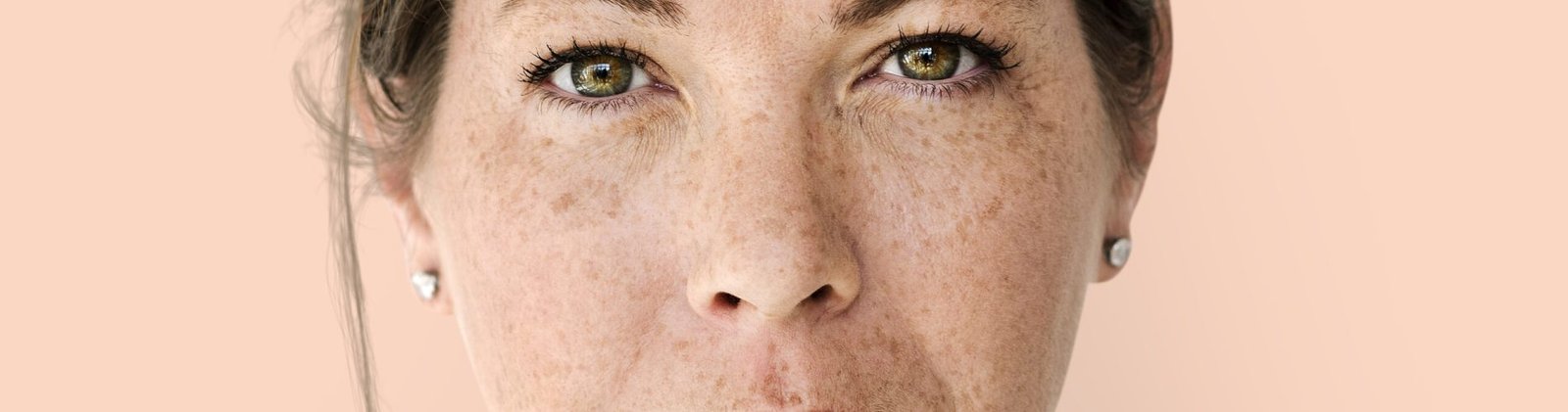 melasma can go away