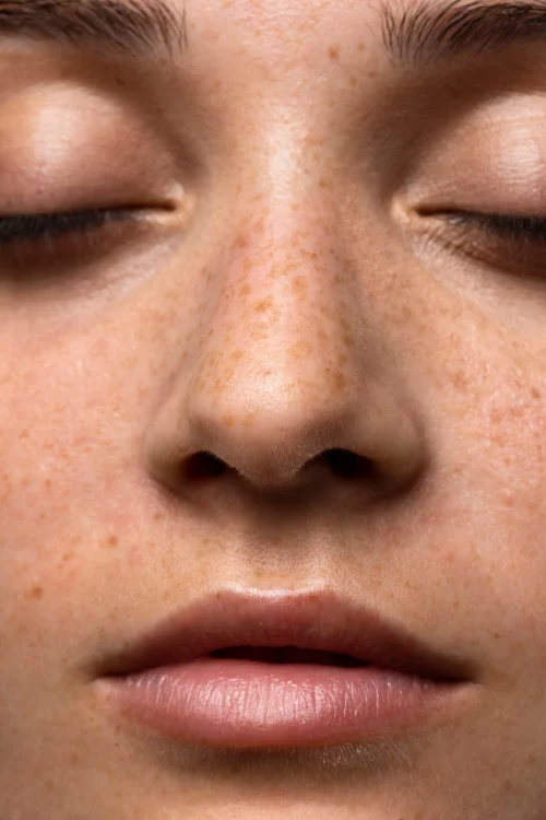 common-mistake-melasma